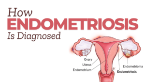 How Endometriosis Is Diagnosed